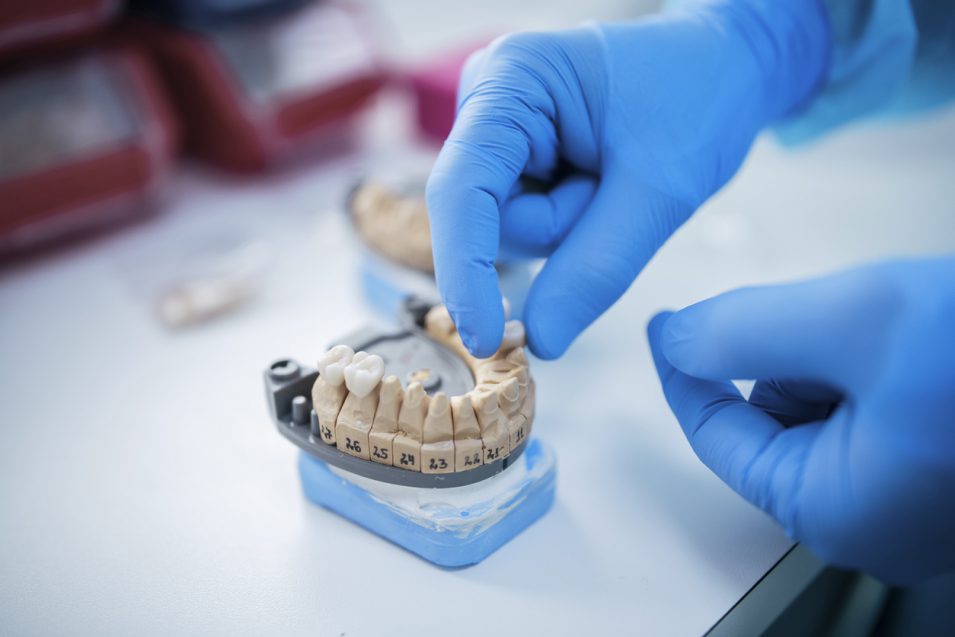 Model Of Dental Bridge To Replace Tooth.