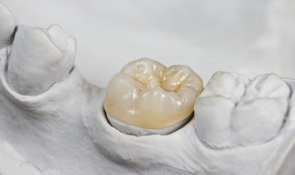 dental onlay on a cast model