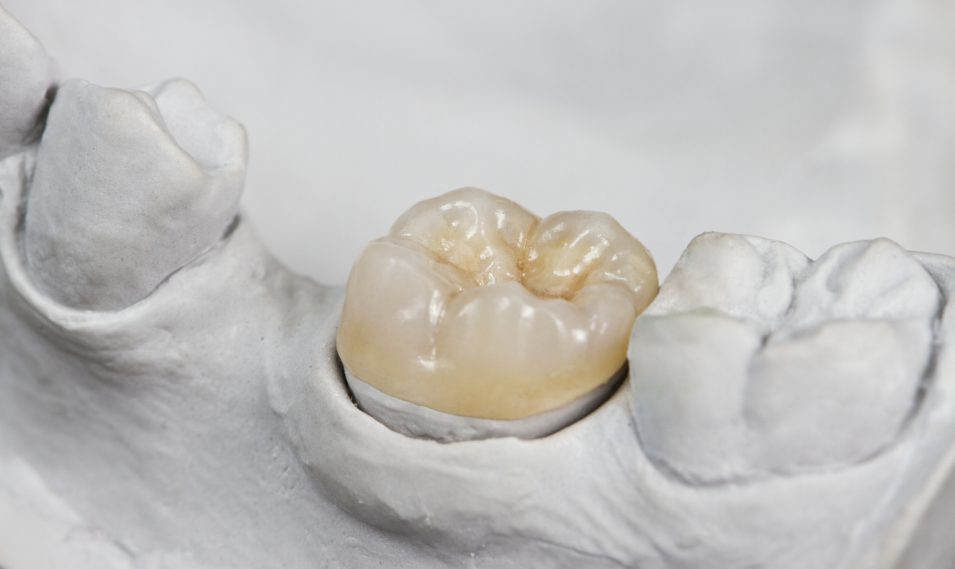 dental inlays and onlays