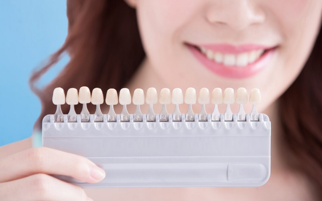 Do You Want a New Smile? Try Veneers