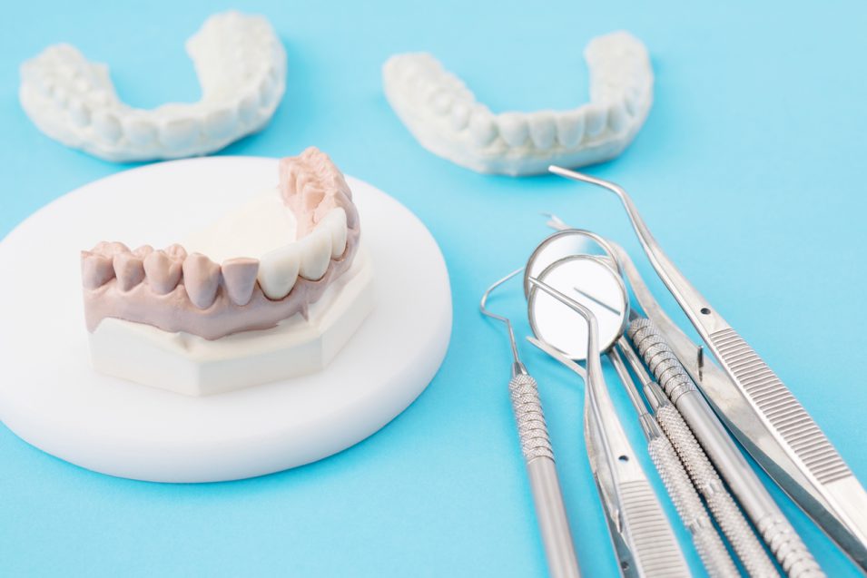 how dental bridges are created