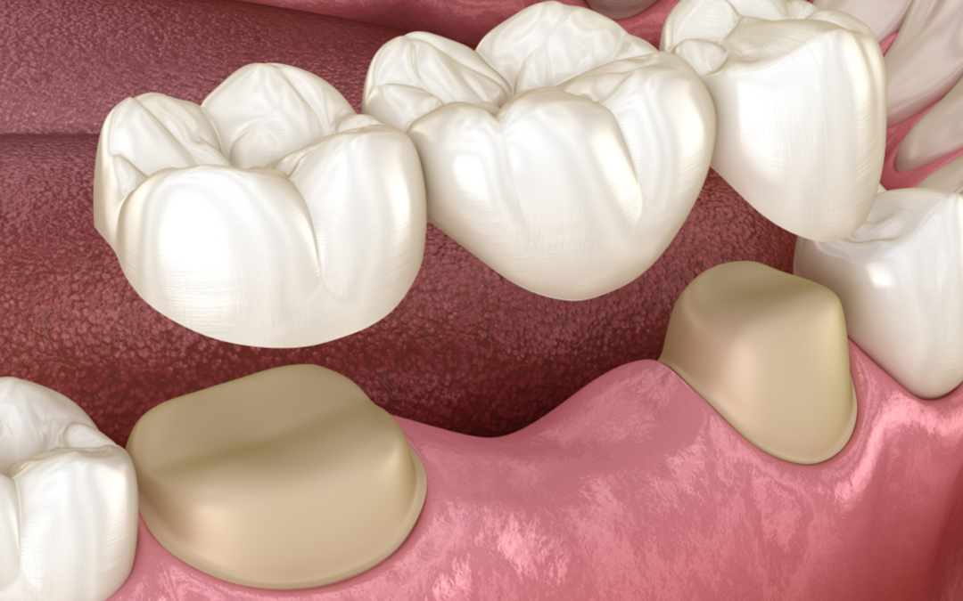 Dental Bridges: Five Must-Know Facts