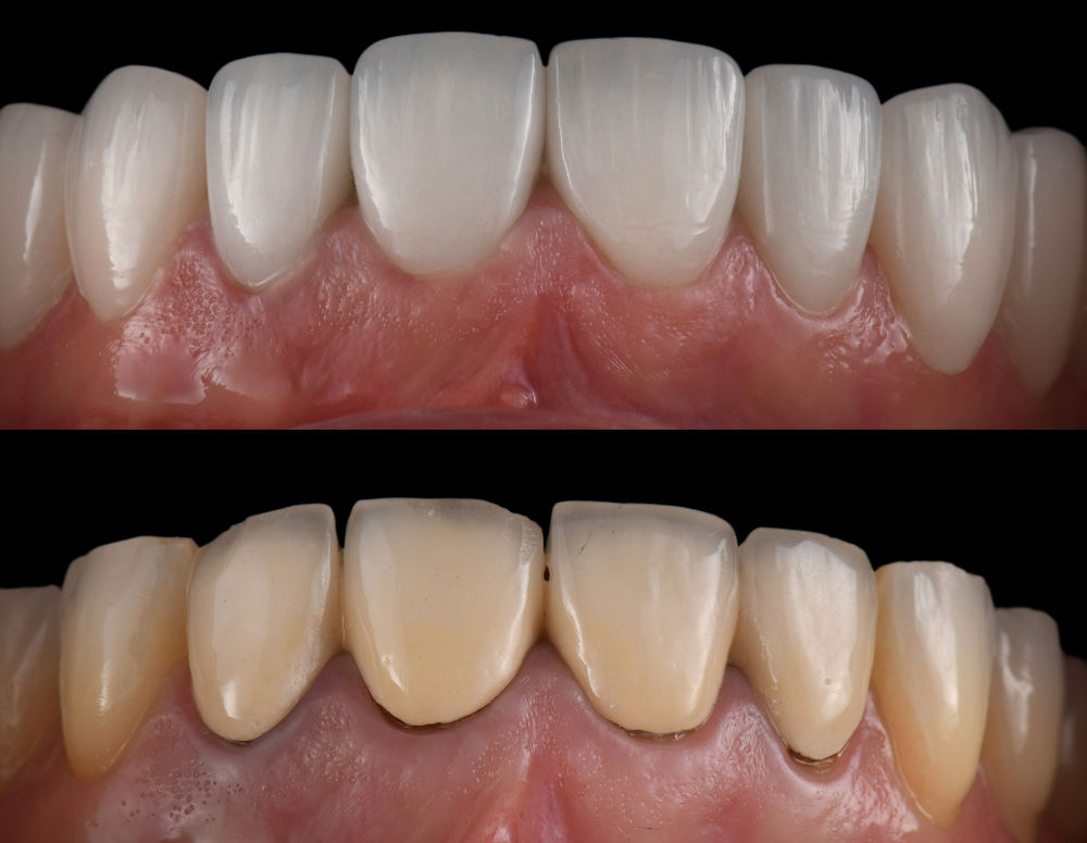 Porcelain Veneers for Long-Lasting Results Close-up of ceramic porcelain veneers showing a smooth, stain-resistant surface and natural translucency compared to bonding.