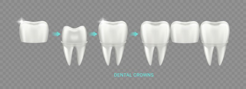 Illustration showing different types of dental crowns used in modern dentistry, including ceramic, zirconia, porcelain-fused-to-metal, and metal crowns.