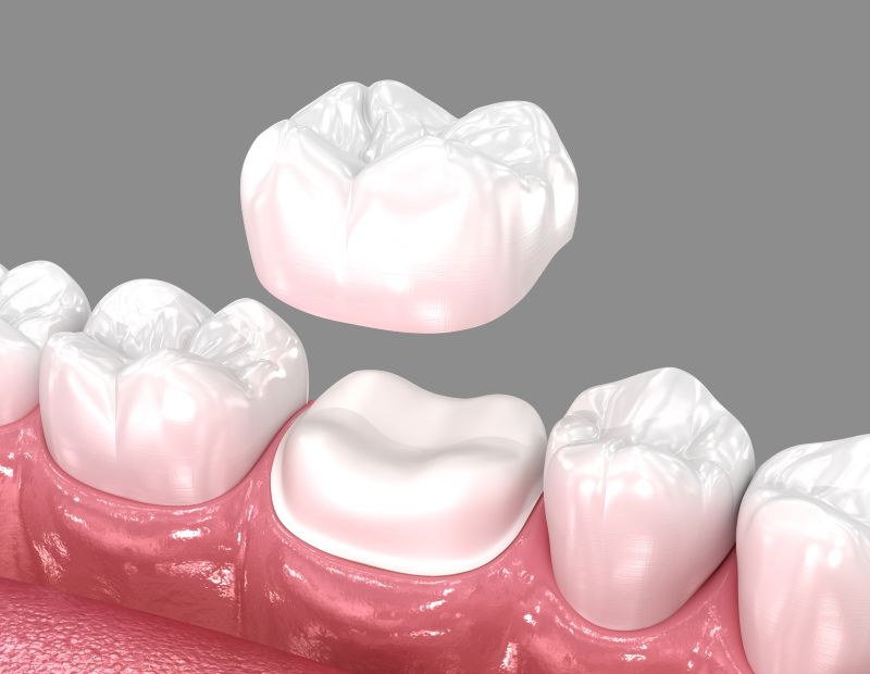 3D illustration showing placement of a ceramic dental crown over a prepared tooth during restorative dental treatment.
