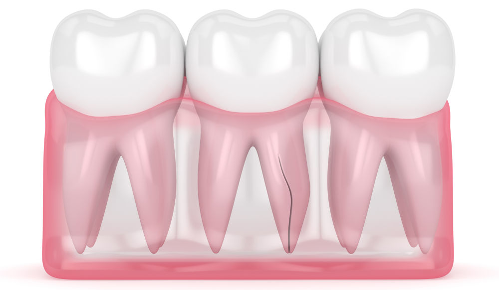 Cracked tooth root damage and infection signs Cracked tooth extending into root causing pain, sensitivity, and possible infection
