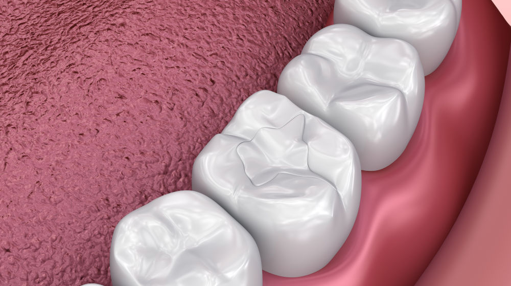 Cracked tooth treatment and restoration options Dental treatment showing repair of cracked tooth using filling or restoration
